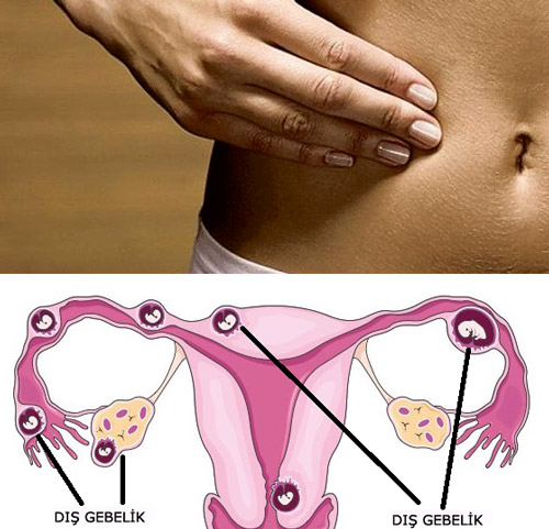 Ektopik Gebelik (Dış Gebelik) belirtileri