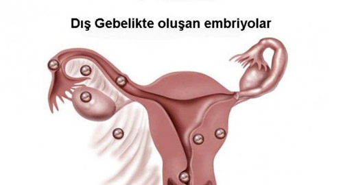 dış gebelik nasıl oluşur
