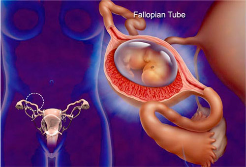 dış gebelik oluşumu