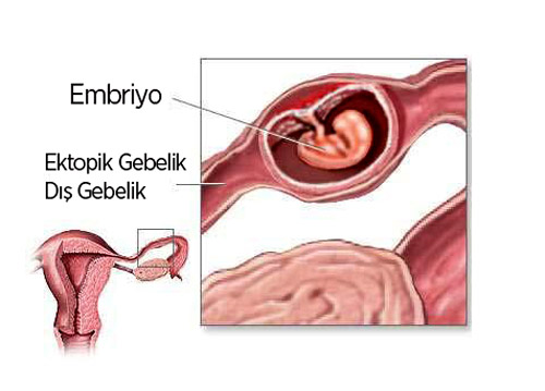 dış gebelik