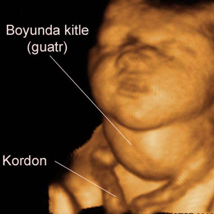 GFetal Guatr Nedir?