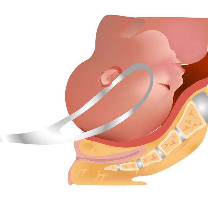 GForseps Nedir?