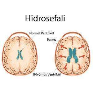 Hidrosefali Nedir?