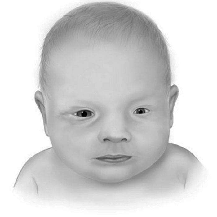 GMikroftalmi Nedir?