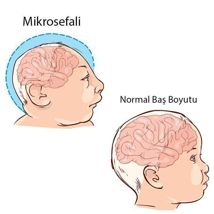 GMikrosefali Nedir?