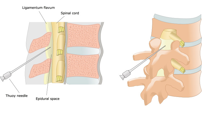 Epidural Anestezi ile Ağrısız Doğum