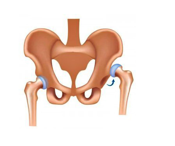 bebeklerde kalça çıkığı