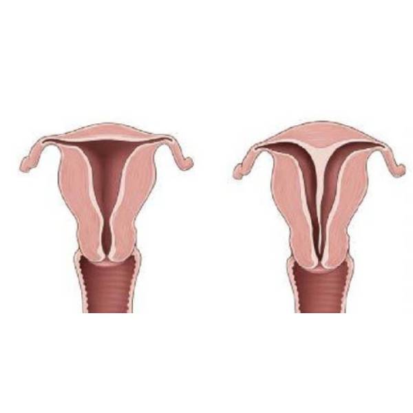Rahimde Perde Olması (septum Uterus) Gebeliğe Engel Midir?