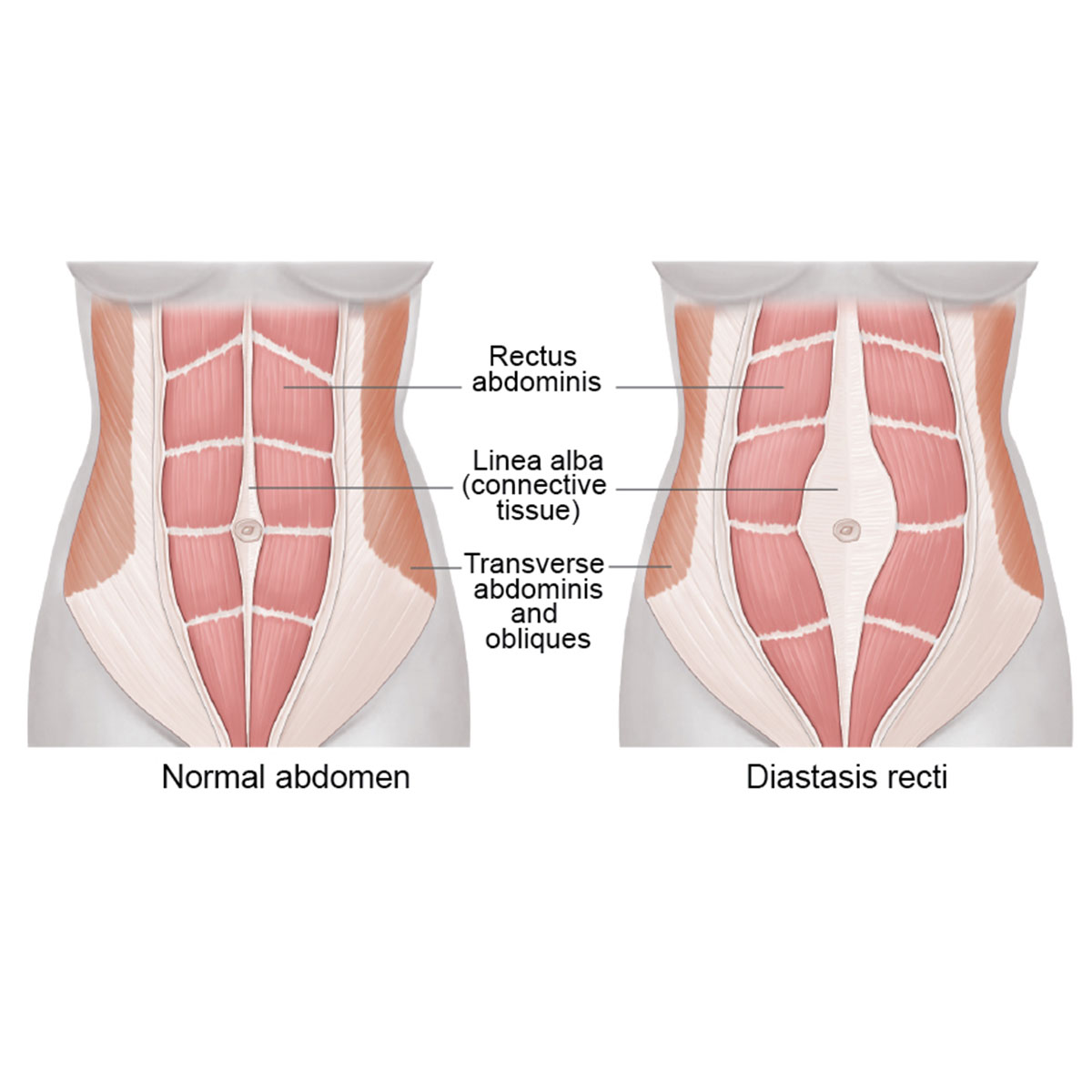 Diastasis Recti (karın Kası Ayrılması) Nedir?