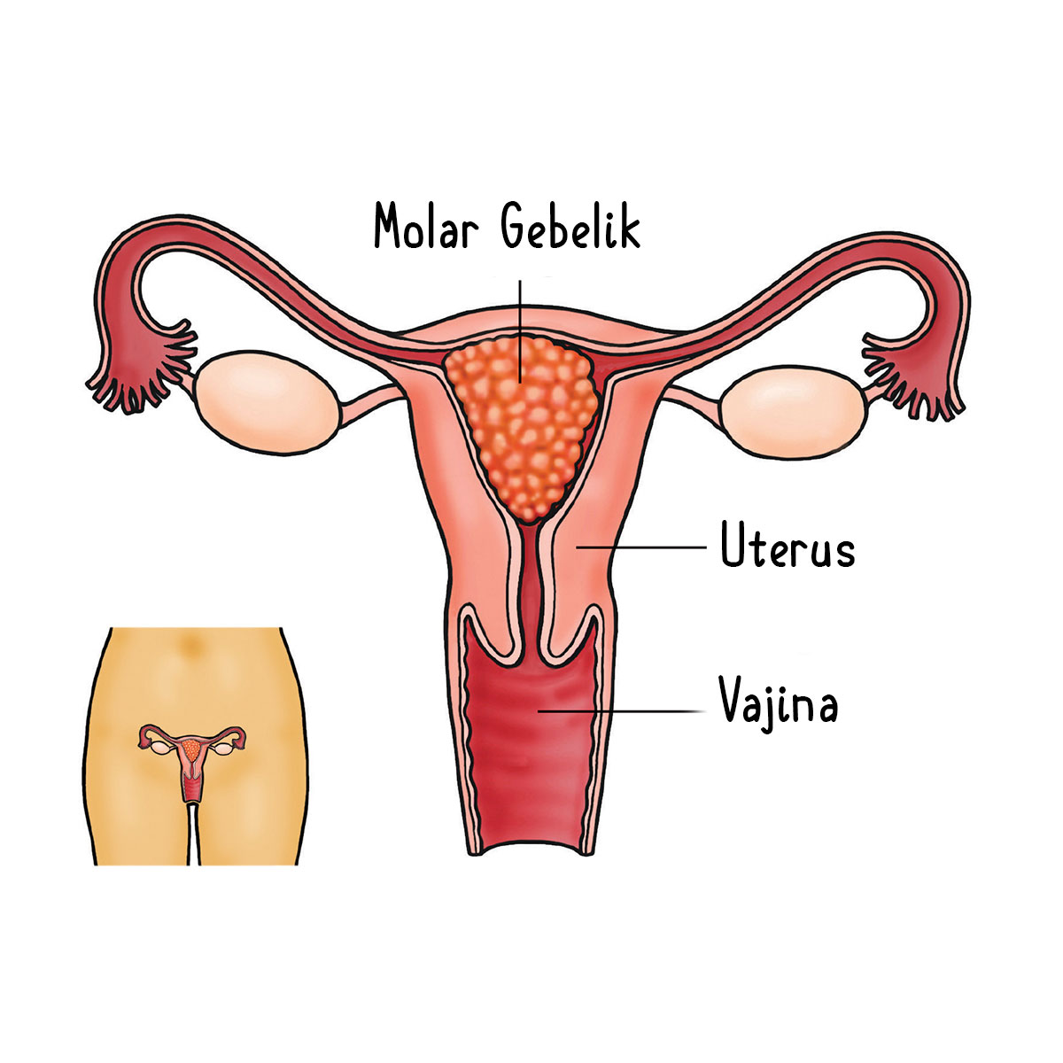 Molar Gebelik Nedir? Belirtileri, Nedenleri Ve Tedavisi