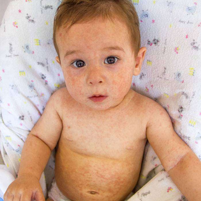 Bebeğinizi İsilikten Koruma Yolları