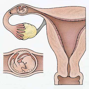 Ektopik Gebelik (dış Gebelik) Hakkında Merak Edilenler