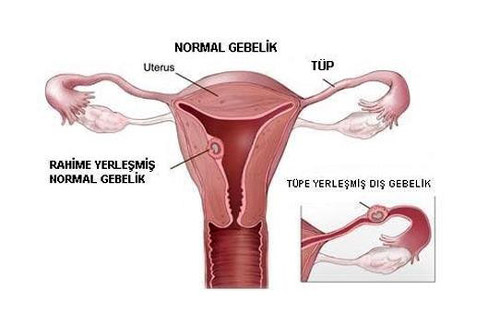 Ektopik (Dış) Gebelik