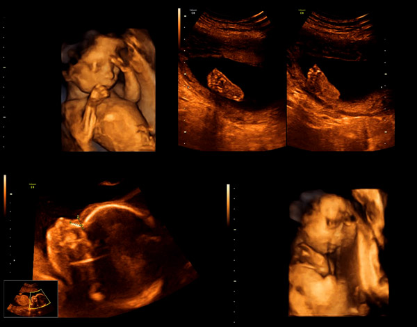 gebelikte anomali taraması