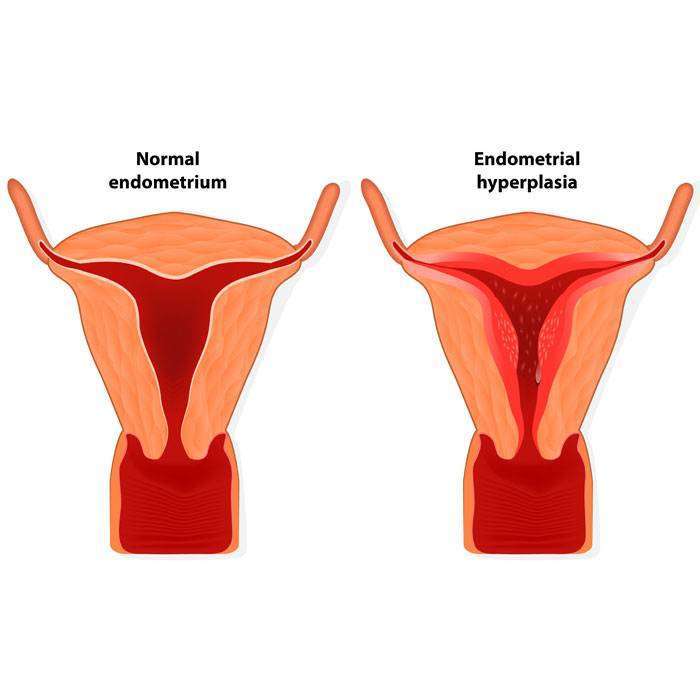 GEndometrial Hiperplazi Nedir?