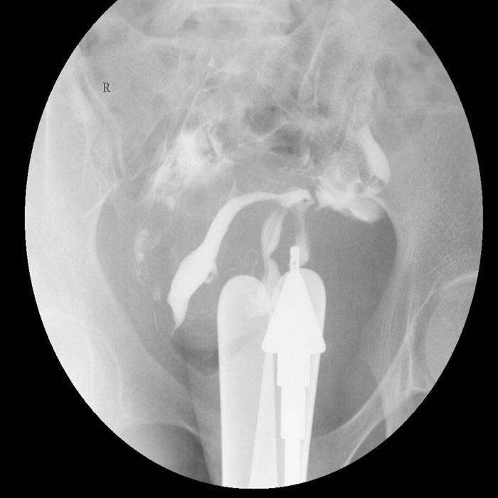 GHisterosalpingografi nedir?