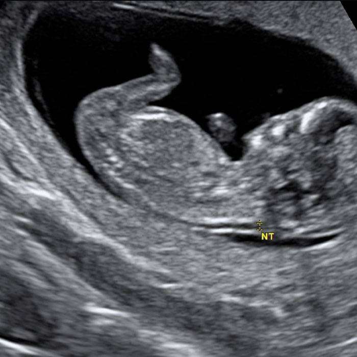 GEnse Kalınlığı Ölçümü Nedir?