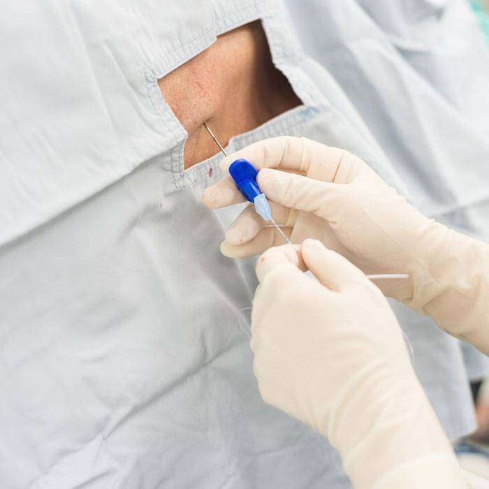 GEpidural Anestezi Nedir?