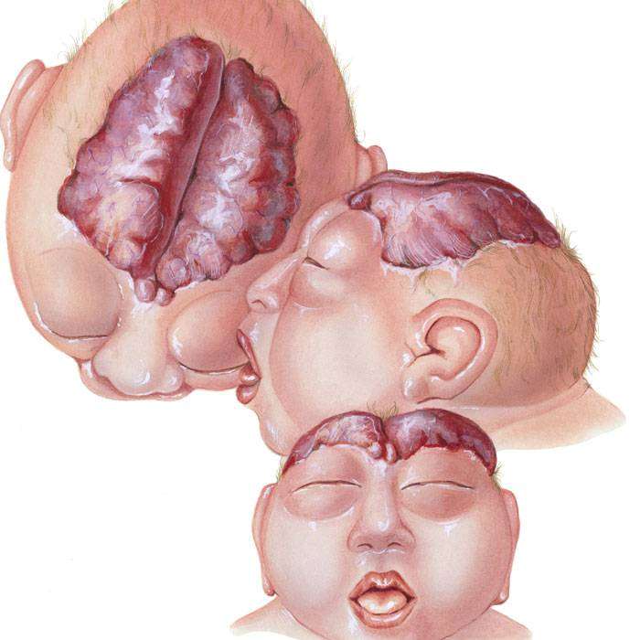 GNöral Tüp Defekti (kusuru) Nedir?