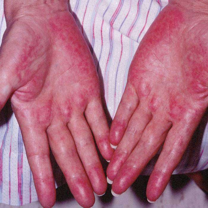 GPalmar Eritem Nedir?