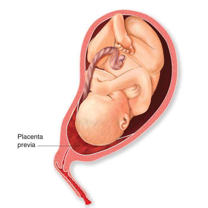 GPlasenta Previa Nedir?