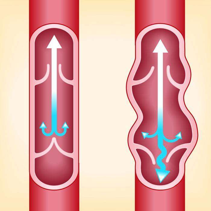 GVarisli Damarlar Nedir?