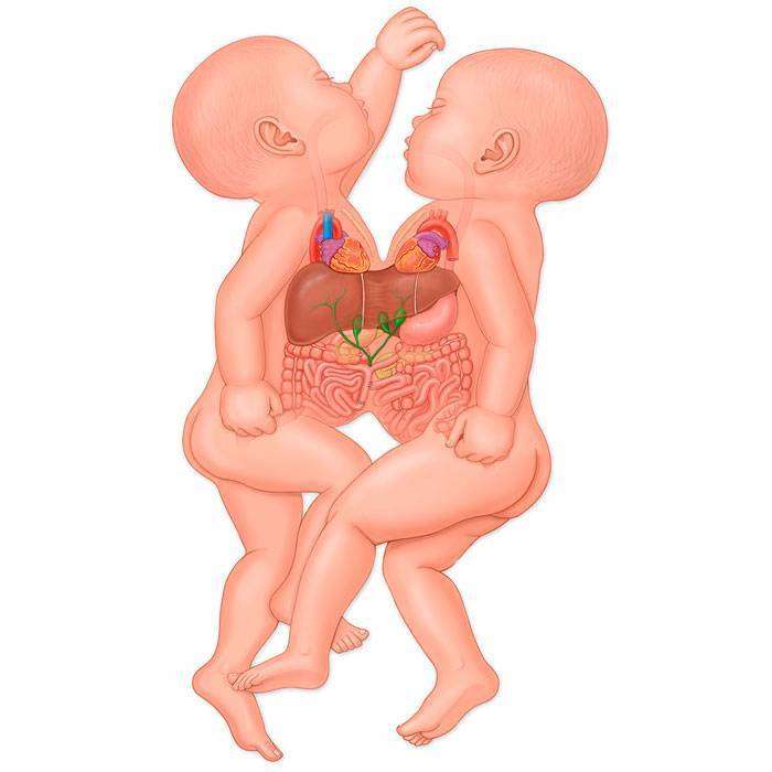 GYapışık İkizler Nedir?