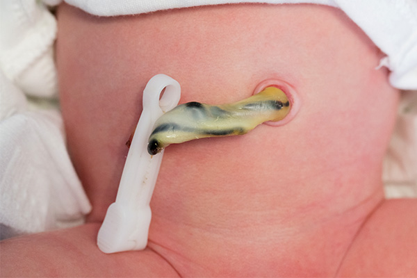 bebeklerde göbek bağı bakımı 