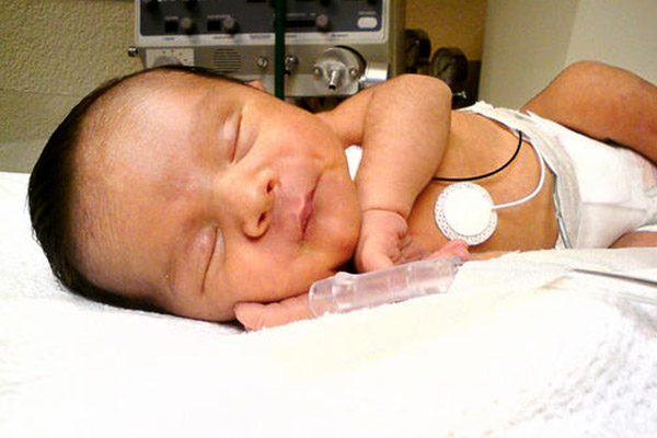 premature-bebek