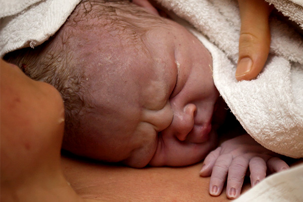 yenidoğan bebeklerde sık rastlanan durumlar