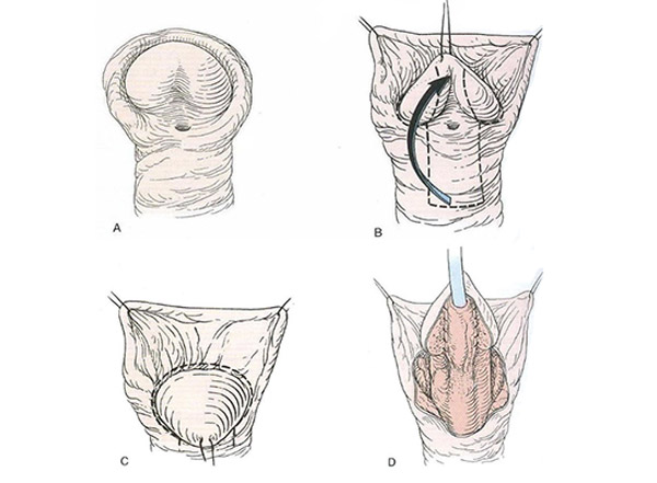 Hipospadias