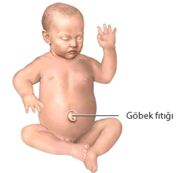 bebeklerde göbek fıtığı