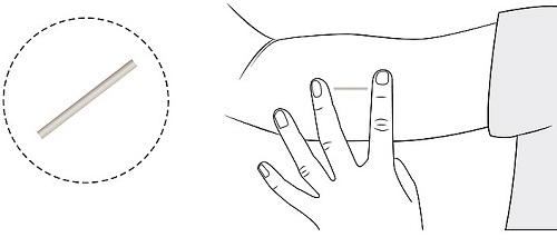 deri altı implant