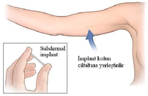 deri altı implant