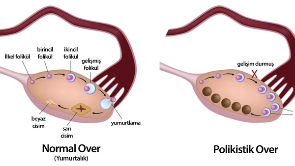 tiroid ve polikistik-over