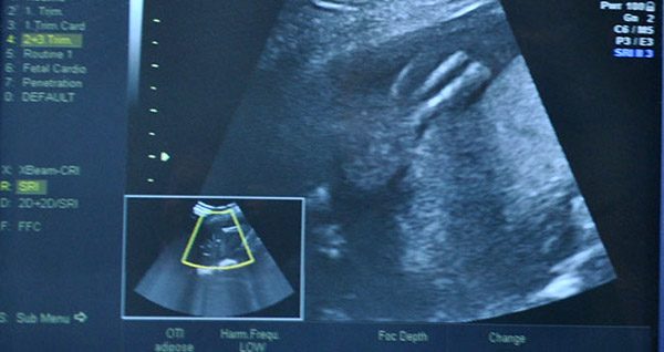 ayağı gelişmeyen bebek 