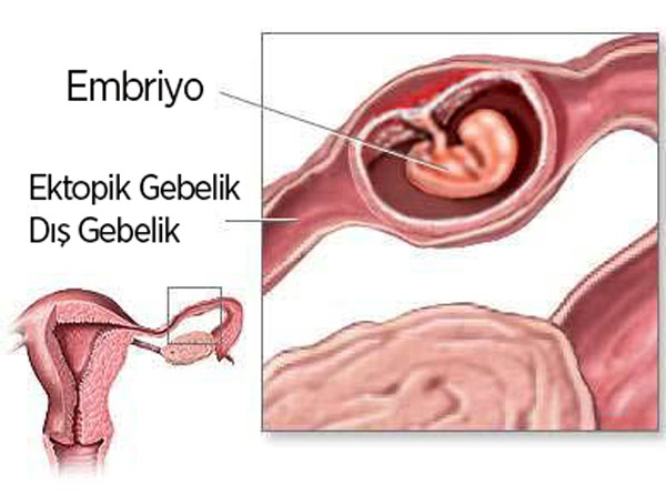 gebelikte kanama dış gebelik