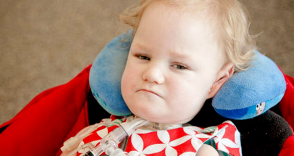 Hipotonik bebek belirtileri