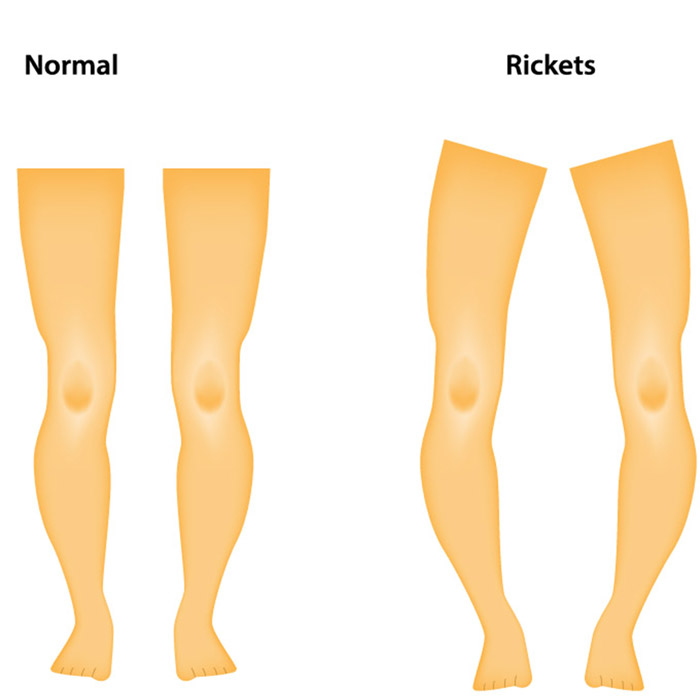 Ülkemizde Sık Karşılaşılan Bir Bebek Hastalığı: Raşitizm