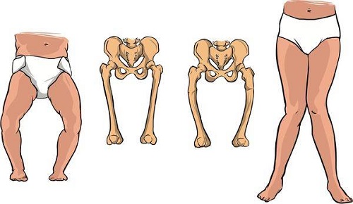 raşitizm belirtileri