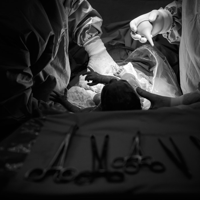 Türkiye Sezaryen Doğumun En Fazla Gerçekleştiği Ülke Oldu