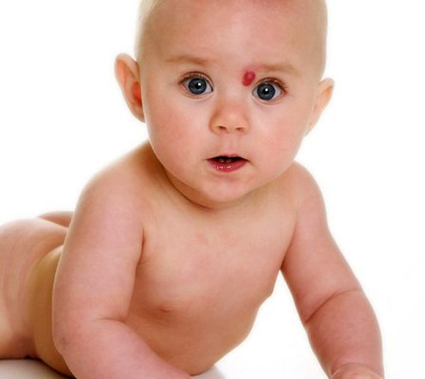 doğum lekesi oluşma nedenleri