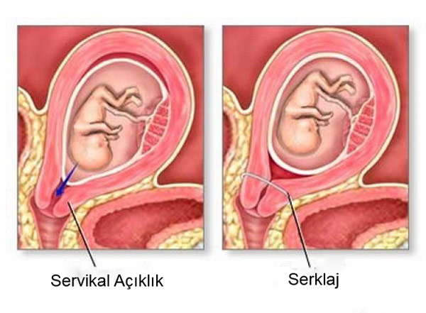 Rahim ağzı yetmezliği 