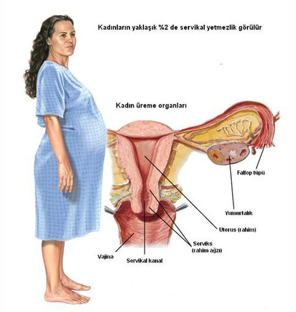 servikal yetmezlik - rahim ağzı yetmezliği