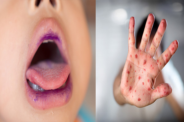 el ayak ağız belirtileri