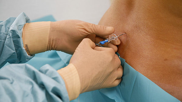 epidural iğne