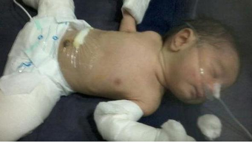 fetüs içinde fetüs