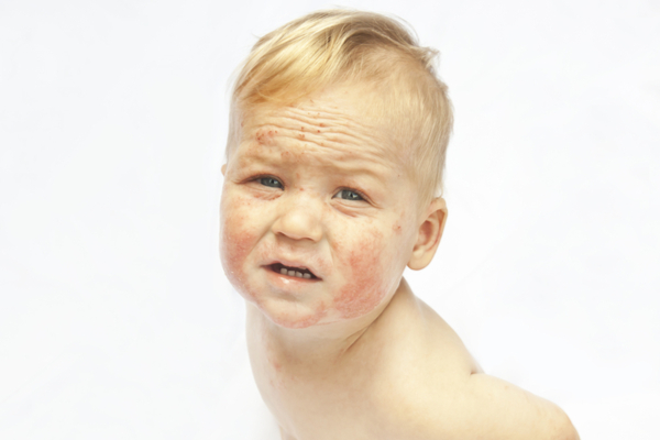 el ayak ağız hastalığı için uzmanlardan uyarı