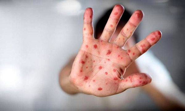 el ayak ağız hastalığı 