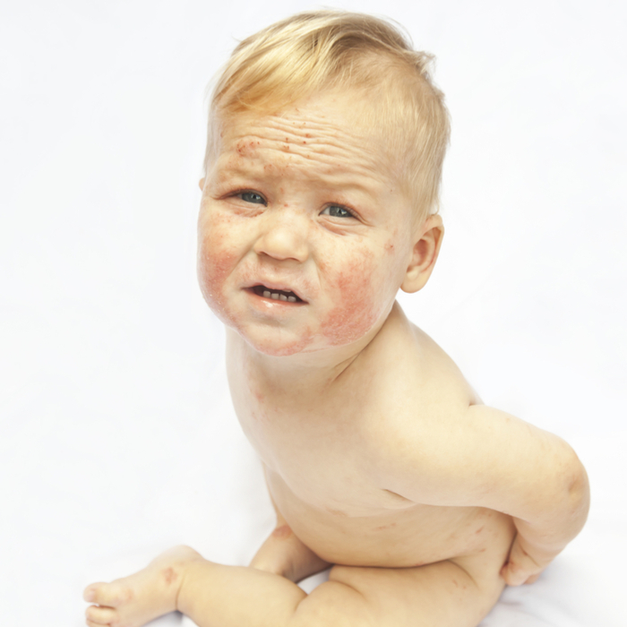 Bebeği 'el Ayak Ağız Hastası' Olan Ebeveynler İçin Önemli Uyarı!